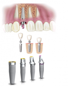 Implantes en Málaga | Miranda Ferrol